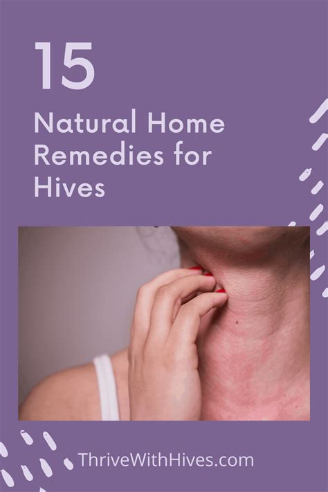 15 Natural Home Remedies For Hives Thrive With Hives