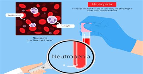 Neutropenia Low Neutrophil Count Types Symptoms And Causes
