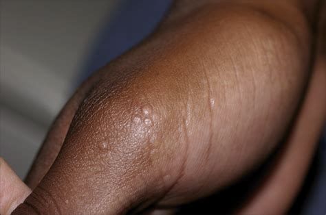 Papules Overlying The Finger Joints—quiz Case Dermatology Jama