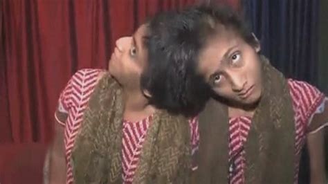 india s famous conjoined twins saba and farah win court battle for financial aid youtube