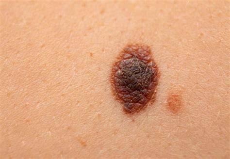 What Does A Cancerous Mole Look Like Pictures Symptoms And Pictures
