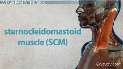 Sternocleidomastoid Syndrome Cause Symptoms And Treatment Lesson