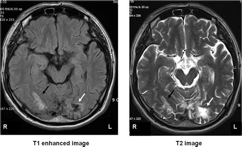 Brain Magnetic Resonance Imaging Mri Revealed An Old Infarct In The
