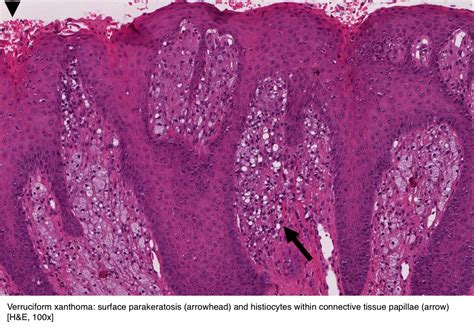 Pathology Outlines Verruciform Xanthoma