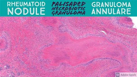 What Is Granuloma Annulare Associated With Trust The Answer