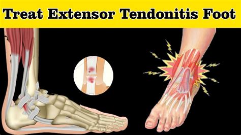 How To Treat Extensor Tendonitis Foot Extensor Tendonitis Foot