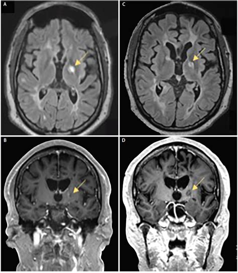 Case Report Hemiparkinsonism In A Patient With Multiple Sclerosis