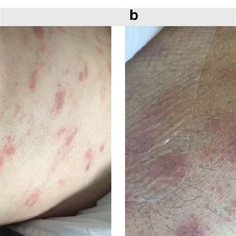 Skin Lesions On Trunk And Upper Limb A Cutaneous Eruption On Trunk B