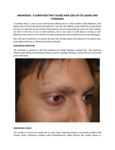 (PDF) MADAROSIS -A CONDITION THAT CAUSES HAIR LOSS OF EYE ...