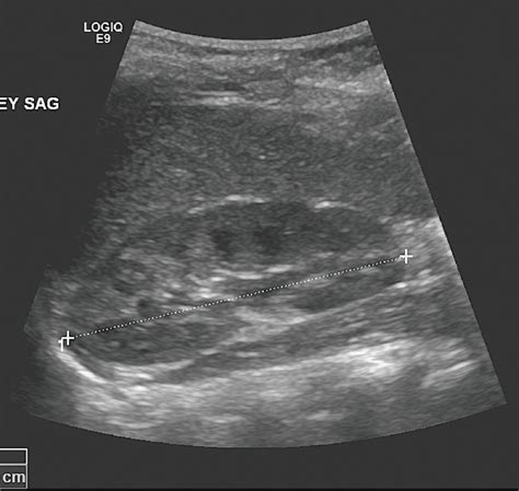 Sonographic Measurements For Kidney Length In Normal Saudi Children