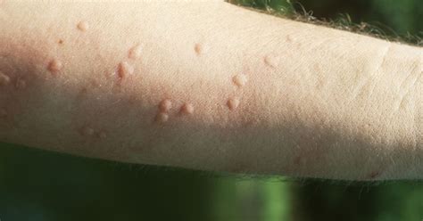 What Are Heat Hives And How Do You Get Rid Of Them Huffpost Canada