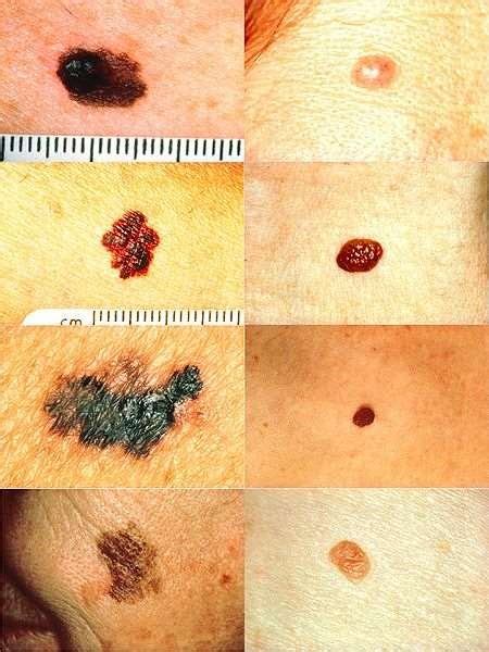 Black And Brown Skin Lesions Malignant Melanoma Information Patient