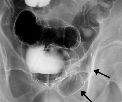 A Spot Fluoroscopic Image From A Double Contrast Barium Enema Study
