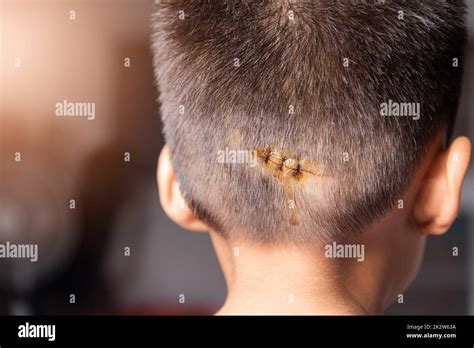 Stitches Boy Hi Res Stock Photography And Images Alamy