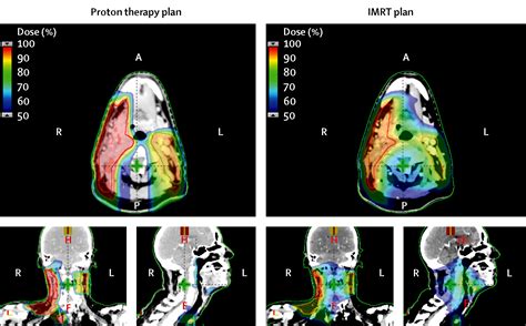 Proton Therapy For Head And Neck Cancer Expanding The Therapeutic