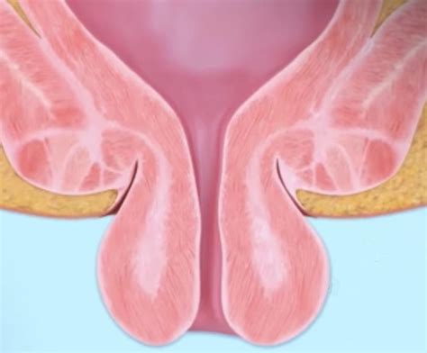 Isolated Rectal Ulcer Syndrome Signs Causes Diagnosis And Treatment