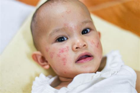 Common Skin Problems In Children Mpumalanga News