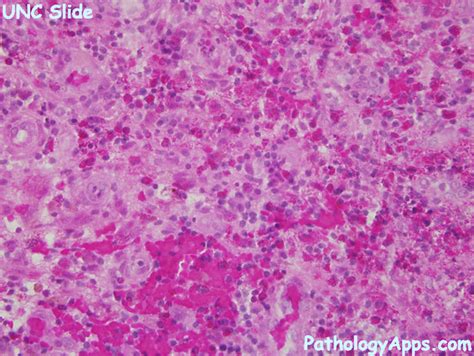 Langerhans Cell Histiocytosis Pathology