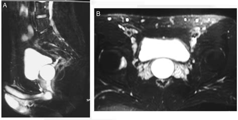 Large Prostatic Utricle Cyst Bmj Case Reports