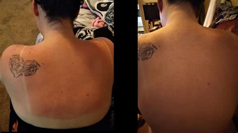Everything About Sunburn On Tattoo Treatment Protection And Healing