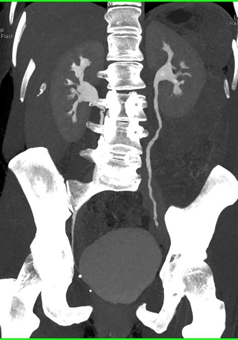 Ct Urogram With Irregular Left Ureter Due To Early Transitional Cell