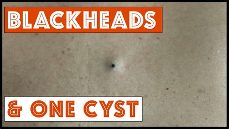 Blackheads And One Cyst Youtube