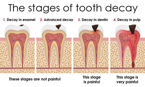 tooth decay dont   statistic premier dental  lees summit