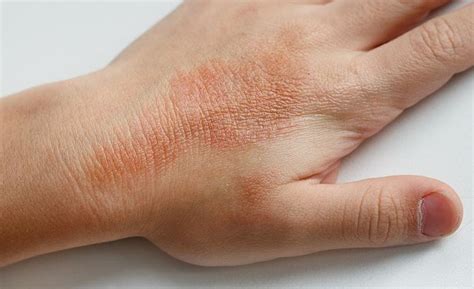 5 Ways To Help Soothe Psoriasis Prone Skin Balcones Dermatology