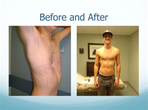 Before And After Center Of Excellence For Pectus