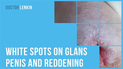 White Spots On Glans Penis And Reddening Of Urethra Youtube