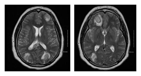 Brain Mri With Contrast Showing Multiple Ring Enhancing Lesions And