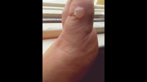 Popping a water blister. 