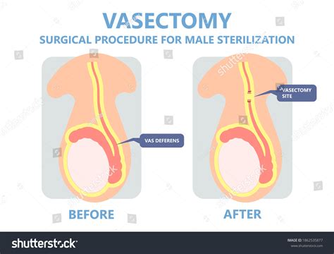 vasectomy male sterilisation ejaculate contraceptive genitalia stock vector royalty free