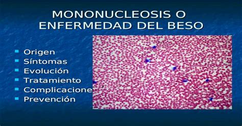 Mononucleosis O Enfermedad Del Beso Origen Origen Síntomas Síntomas