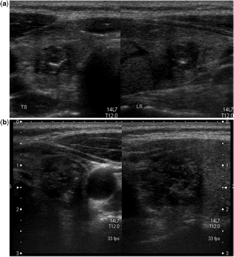 Images From A Patient With Multifocal Papillary Thyroid Carcinoma Are