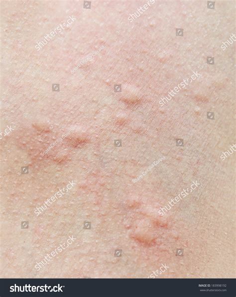 Close Human Skin Presenting Allergic Reaction Stock Photo 183998192