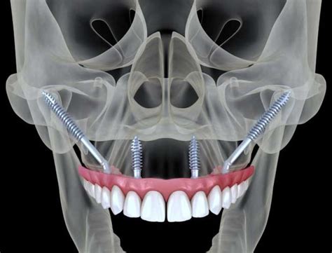 Are Dental Implants An Option If Ive Suffered Jaw Bone Loss