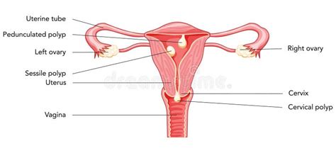 Polyp In The Uterus With Inscriptions Diagram Female Reproductive System In Cross Sections