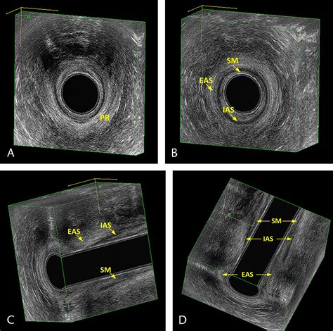 Endoanal Ultrasound In Perianal Fistulae And Abscesses Ultrasound Quarterly
