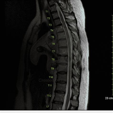 T2 Mri Thoracic Spine With And Without Contrast Shows Resolution Of