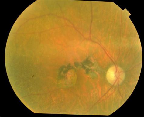 Fundus Photograph Of The Right Eye Showingatrophicmacular Scar