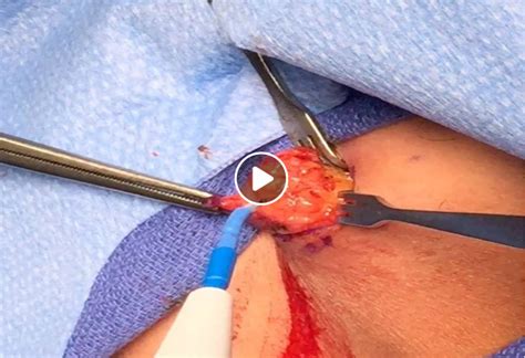 Back Cyst Viral On The Web Now