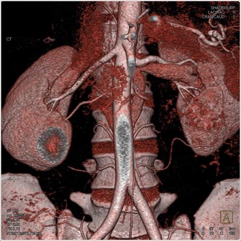 Two Right Renal Arteries Kidney Case Studies Ctisus Ct Scanning