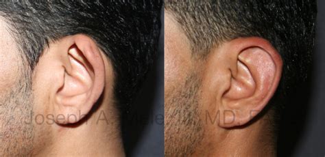Otoplasty Cosmetic Ear Surgery And Ear Pinning Sf Bay Area