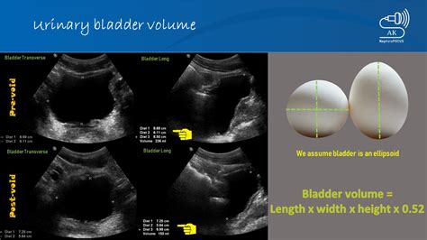 Urinary Bladder Volume Measurement On Pocus We Assume Grepmed