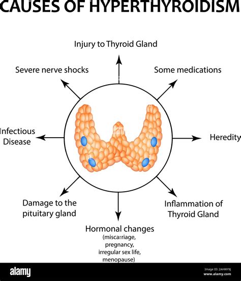 The Causes Of Hyperthyroidism Of The Thyroid Gland Infographics