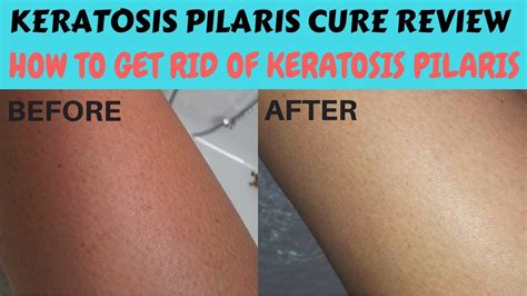 Keratosis Pilaris Cure Review How To Get Rid Of Keratosis Pilaris