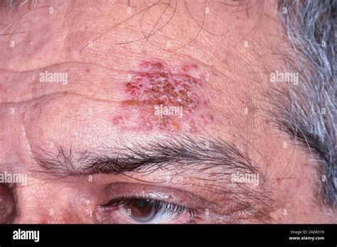 Shingles Rash Close Up Of A Rash On The Forehead Of A 62 Year Old Male