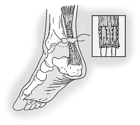 Open Repair Of Acute Achilles Tendon Ruptures Foot And Ankle Clinics
