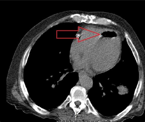 Cureus Systemic Air Embolism Following Computed Tomography Guided